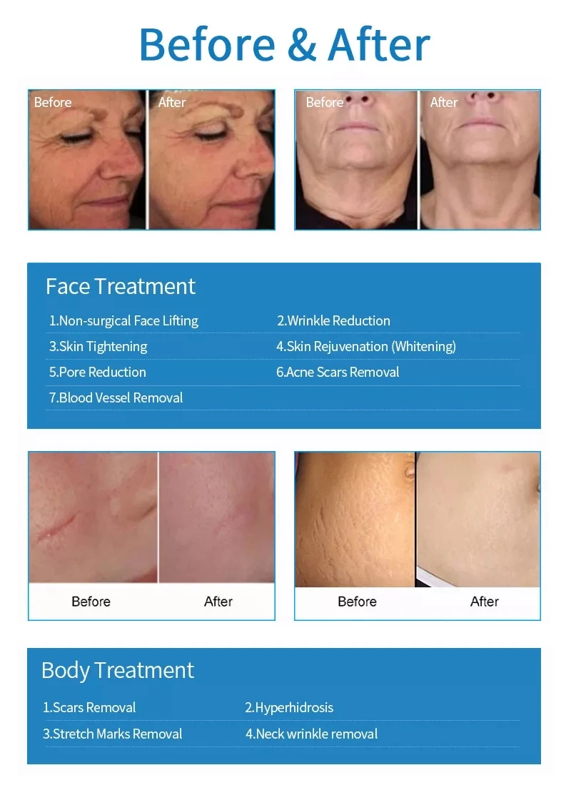 フラクショナルRFスキンリフティング フラクショナルRFスキンリフティング