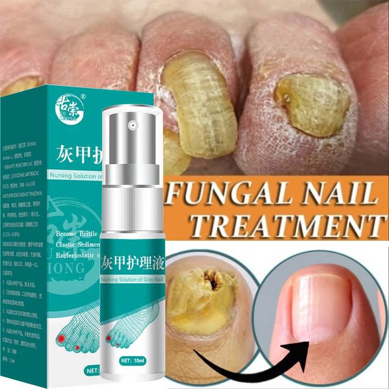 

Nail Fungus Treatments Serum Spray Repair Toe Nail Fungal Removal Serum Anti-Infection Onychomycosis Paronychia Nail Treatment