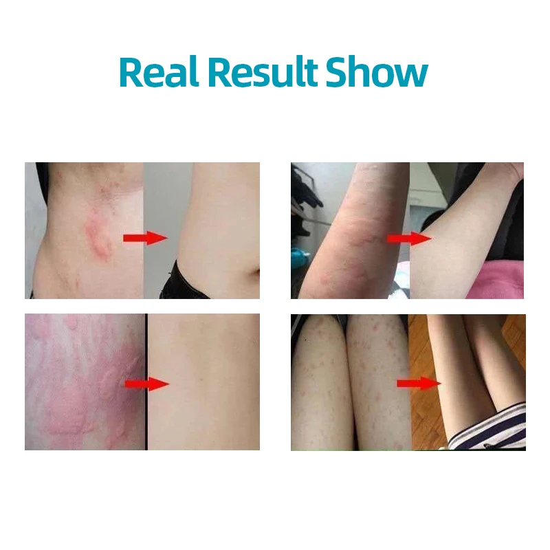Dermatitis Atopica Antipruritic Medicine Cream Treatment Seborrheic Eczema Allergy Pruritus Medical Bacteriostatic Ointment