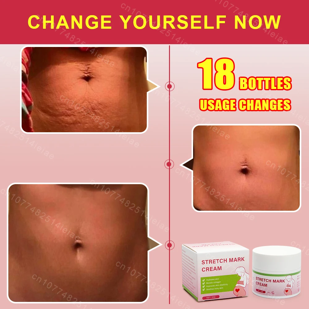 Pregnancy Mark Removal Cream Permanent Repairs Damaged Skin Natural Ingredients Remove Abdominal Pregnancy Line Without Stains