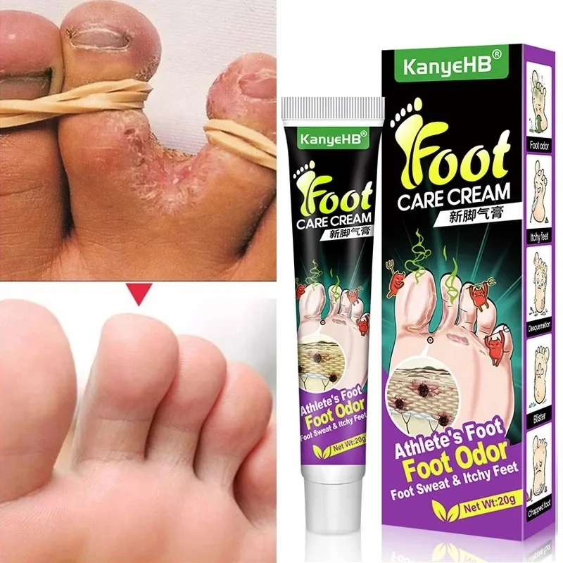 

Foot Fungus Removal Cream Anti Fungal Infection Onychomycosis Paronychia Remove Beriberi Dead Skin Repair Foot Cracked Feet Care