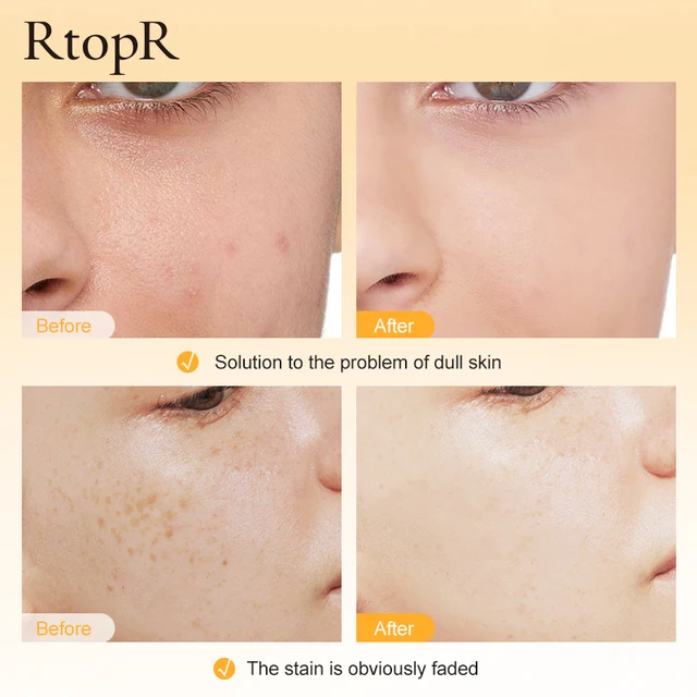 Rtopr Viamin C Fehérítő Szérum Javítás Bőr Fényes Színe Hidratálás Csökkentse A Melanin Tisztességes Ráncátviteli Bőrápolást - Image 3