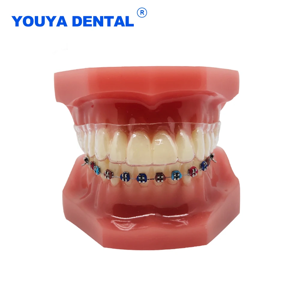 Orthodontic Models Dental Model With Braces With Ortho Metal Ceramic
