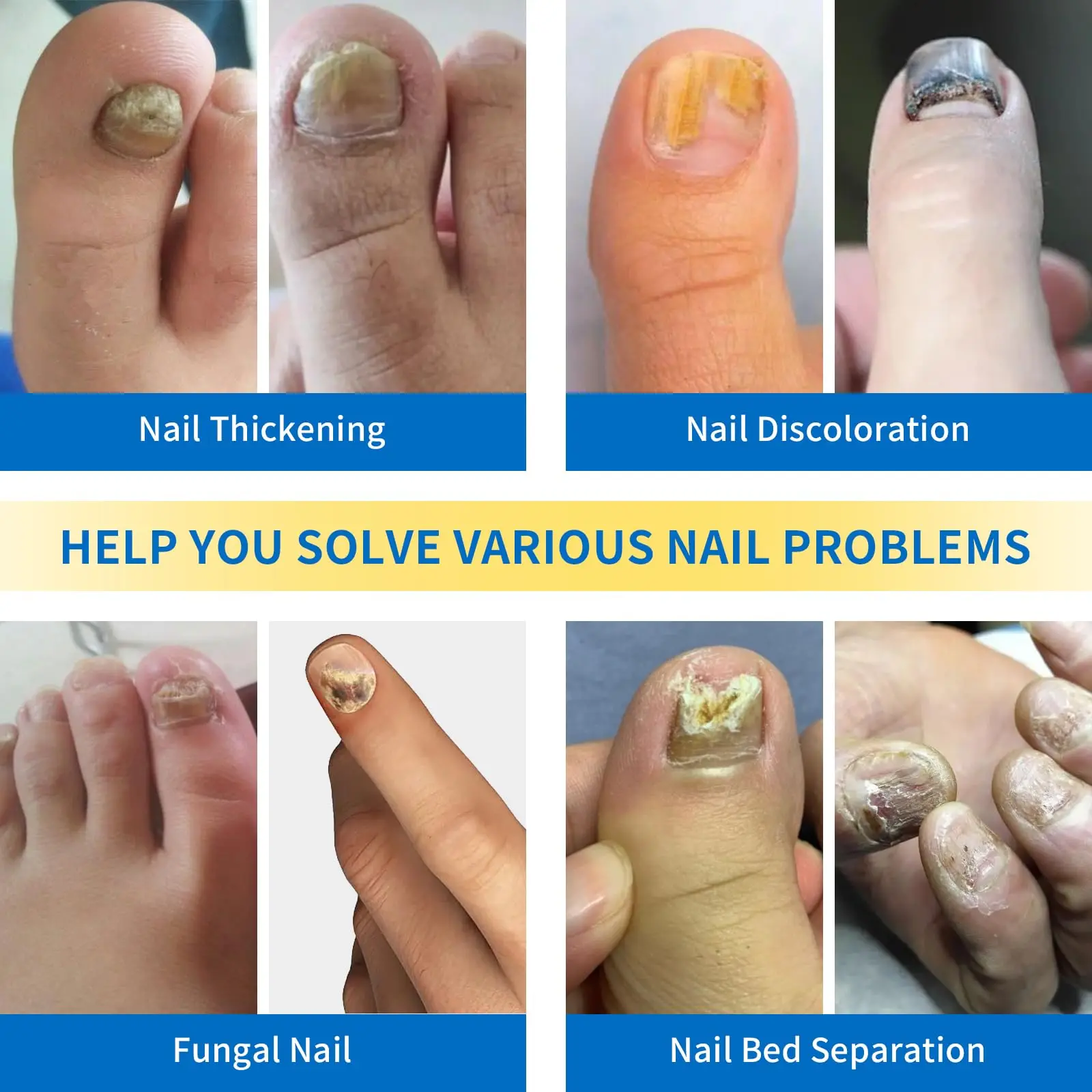 Nail Cleaner Laser Device Effective Serum Nail Correction Recover Oil Pain Reliever Softener Repair Foot Care