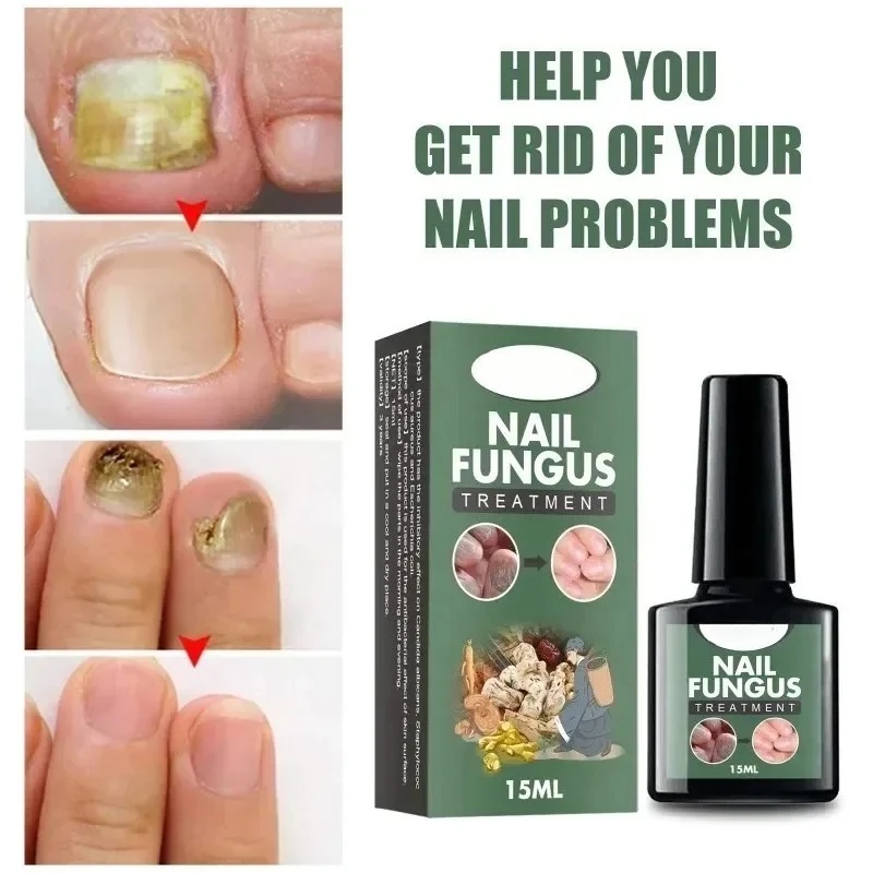 Nail Fungal Treatment Essence Oil Foot Toe Nail Fungus Removal Serum 7 Days Repair Onychomycosi Anti Infection Gel
