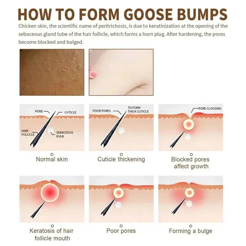 كريم إزالة جلد الدجاج ، إصلاح الجسم ، التقرن ، بيل...