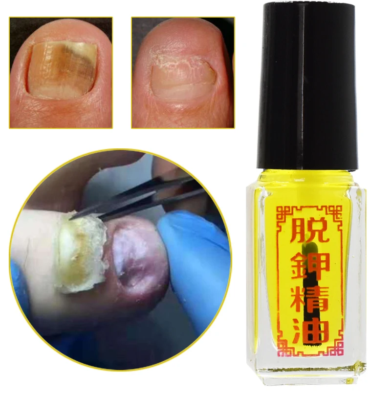 

Chinese Medicine Fungal Nail Treatment Essence Nail and Foot Whitening Toe Nail Fungus Removal Feet Care Nail Gel 30ml