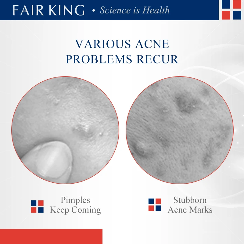 FAIRKING Tea Tree AcneCream Fade Pimples Skin CareScars Repair Removal Pore Shrinking Control Moisturizing Smoothing Skin Care