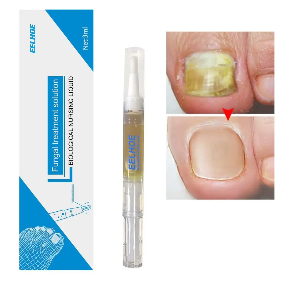 

Nail Repair Liquid Anti Fungal Treatment Nail Pen Onychomycosis Paronychia Infection Chinese Herbal Finger Nails Health Care