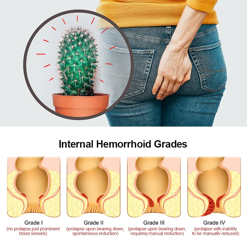 Anal treatment product for Anal fissure rectal bleeding pain anal bleeding and swelling reduction