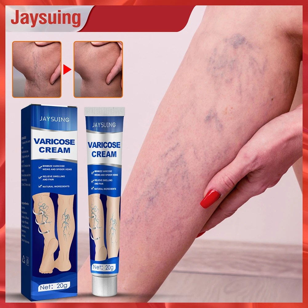 2Types Varicose Vein Ointment Phlebitis Vasculitis Treatment Cream