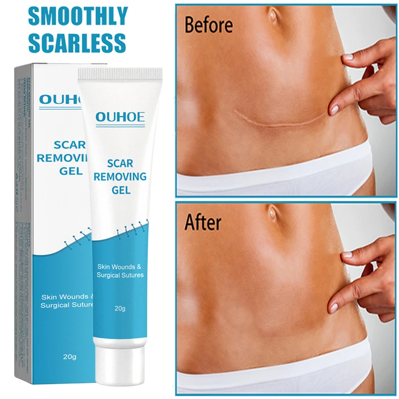 

1-5PCS Scar Removal Cream Effective Acne Treatment Pimples Stretch Marks Burn Repair Gel Moisturising Smoothing Skin Body Care