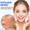 Hoygi Fast Results Dilute Reduce Spots And Acne Refreshing B5 Melasma & Dark Spots Moisturizing Skin Spots & Acne Ampoule 5