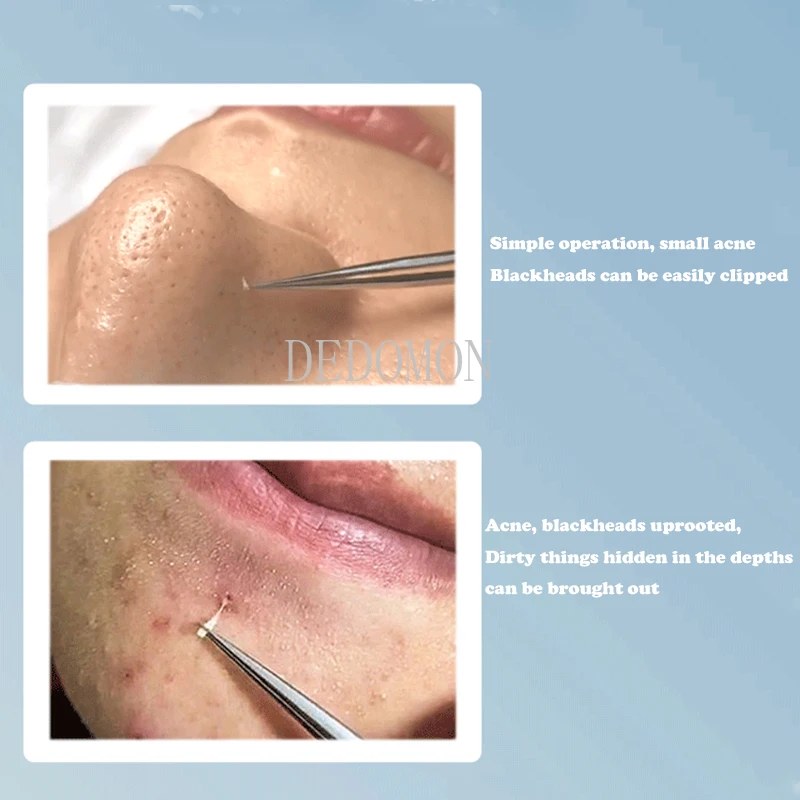 MR.GREEN Ingrown Hair Tweezers Needle Nose Pointed Tips Eyebrows