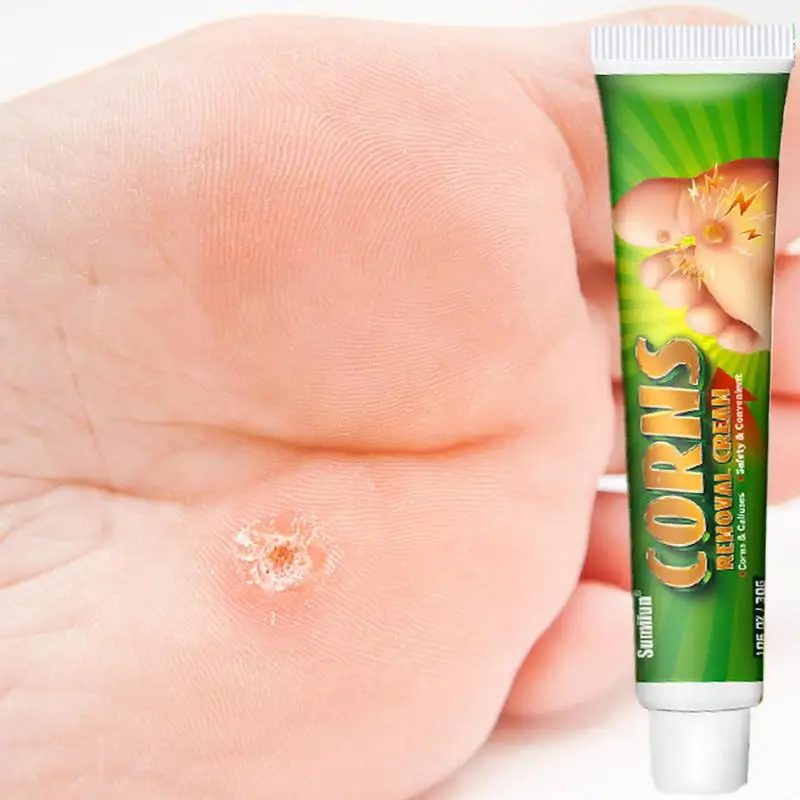 Corns Removal Foot Cream 30g Remove Calluses Safe And Convenient Foot
