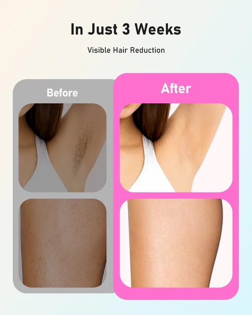 Depilazione laser 990000 flash per donne e uomini Corpo Bikini e aree facciali Depilazione permanente indolore Depilazione IPL 6