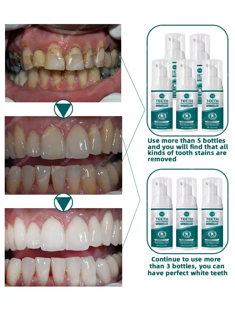 Whiter Teeth, Confident Smile