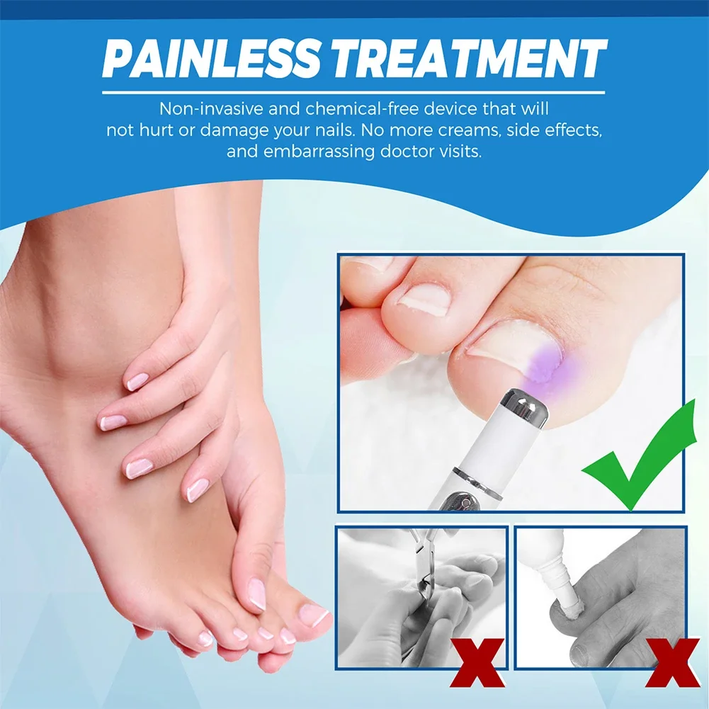 Nail Fungus Treatment Pen Anti-fungal Repair Pen Blue Light Laser Paronychia Nail Onychomycosis Painless Removal Care Tool