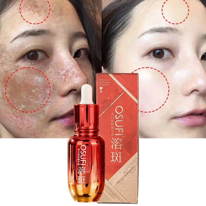 Niacinamide Whitening Freckle Serum Remove Melasma Dark Spot Lightening Pigmentation Brightening Beauty Facial Skin Care 50ml