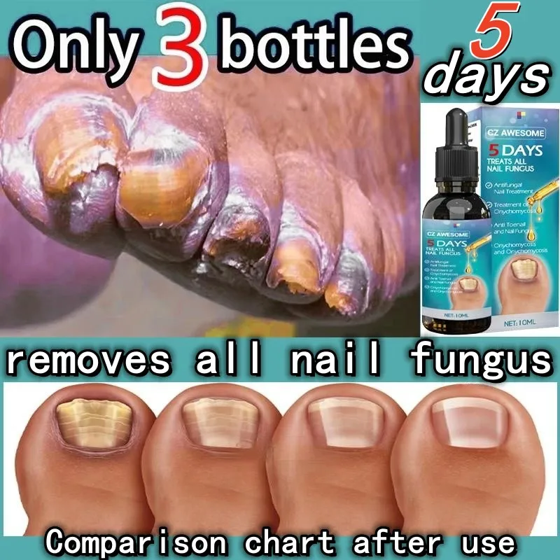 Manicure Foot Care Essence, Branqueamento do pé do prego, Unha fungo remoção Gel, Tratamento anti infecção onicomicose