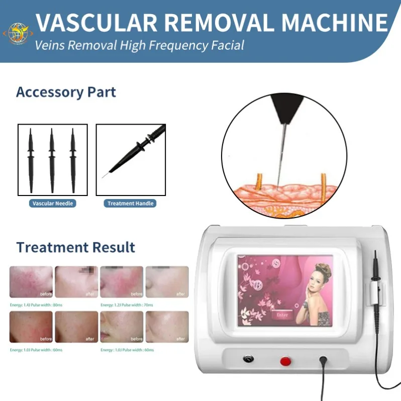 

Beauty Equipment 30Mhz Vascular Removal R-F E Vascular Removal Ode Nail Fungus Treatment High Frequency Machine