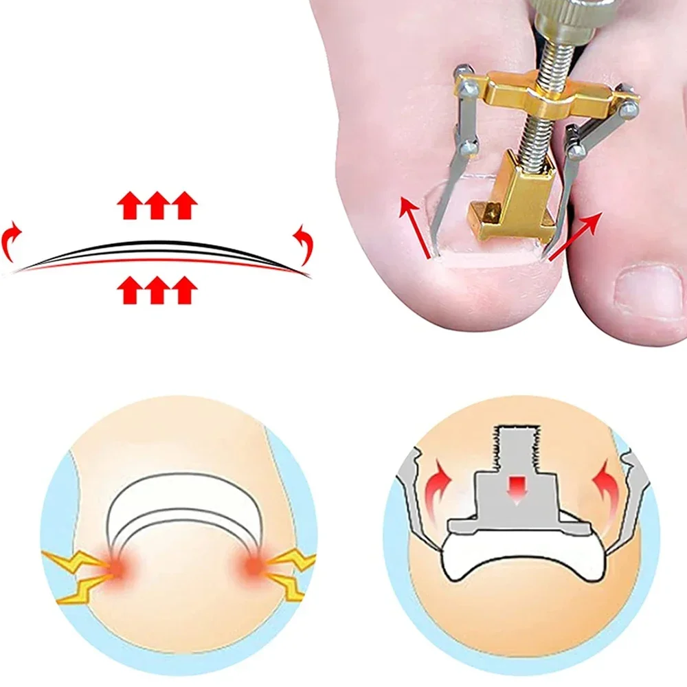 Ingrown Toenail Correction Patch Stickers Ingrown Toenail Treatment Lifter Toe Nail Patch Correction Buckle File Cuticle Pusher