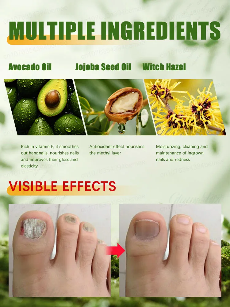 Laser Product To Solves Nail troubles