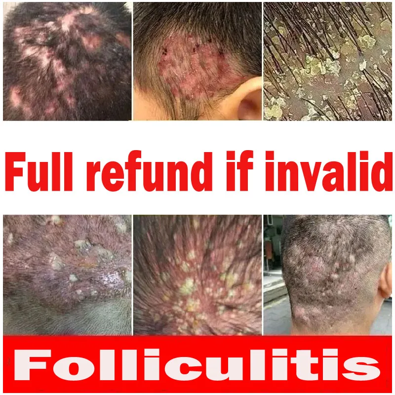 Chemical Burn On Scalp Symptoms visitchile.cl