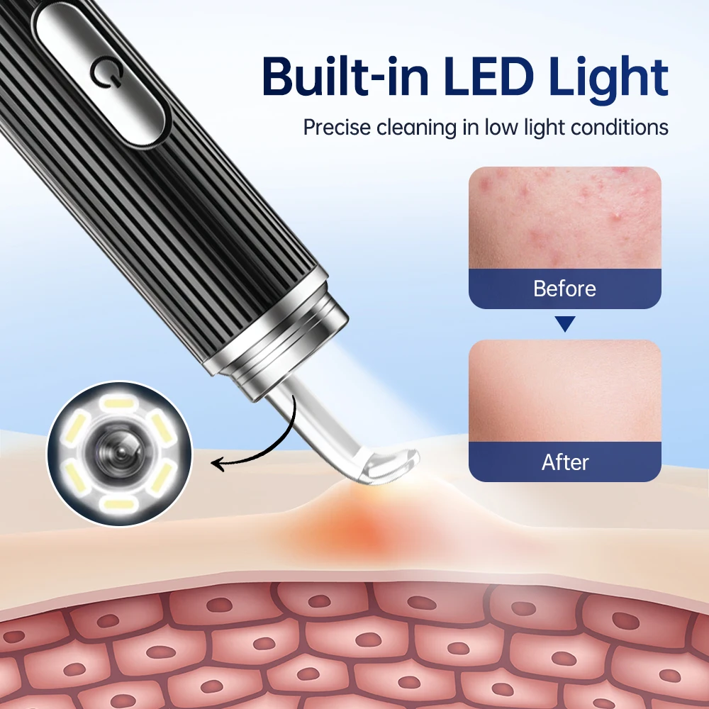 ABS Blackhead Remover Tool with 50X Magnification for Acne and Pore Cleaning