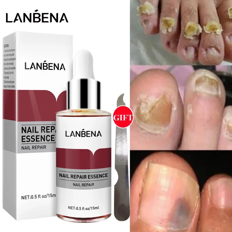 

LANBENA Nail Repair Essence Fungus Removal Gel Anti Infection Paronychia Onychomycosis Hand Foot Nails Treatment Protection Care