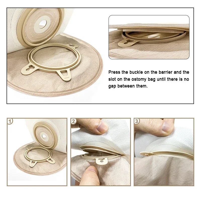 10barriers/15bags + 6barriers Ostomy Supplies Colostomy Bags Two Piece Drainable Pouches hoop look Ileostomy Stoma Care