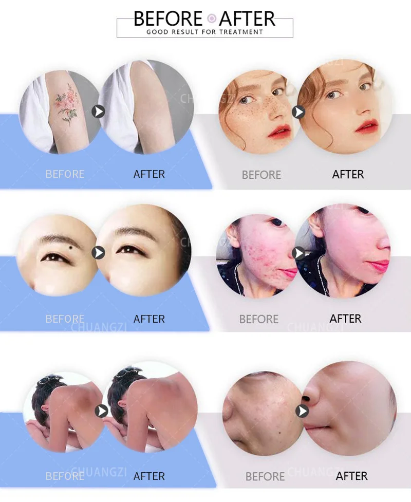 

Professional Q-Switch Nd-YAG portable eyebrow pigment removal machine skin whitening beauty salon Carbon stripping 1064/532/755