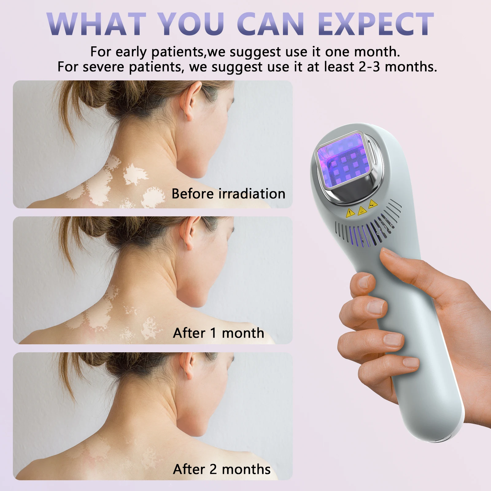 KTS Vitiligo Lamp for Home Use 308nm UVB Lamp for Vitiligo Ultraviolet Phototherapy Device Psoriasis Spots Eczema Skin Disease
