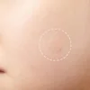 24pcs Face Acne Pimple Spot Scar Care Treatment Stickers Facial Skin Care Blackhead Removal Freckle Patches Acne Mask Beauty 5
