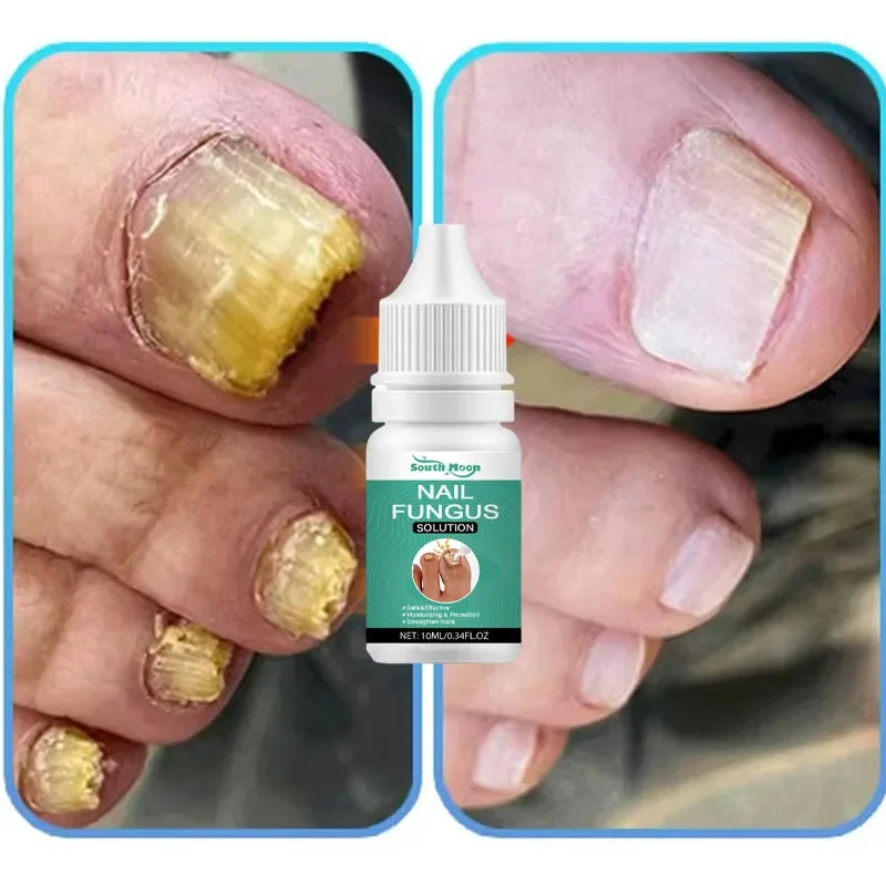 שמן אסנס לטיפול בפטרת ציפורן, מכשיר לייזר לטיפול בפטרת ציפורן, תיקון ציפורן, טיפוח ציפורן, ג'ינג'ר וטיפול בידיים ורגליים