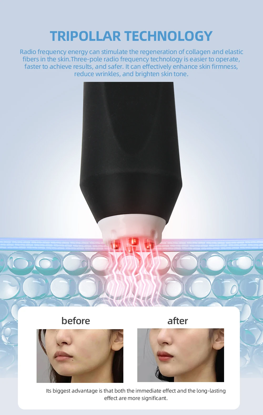 3-in-1 CO2 Nano-Blasen Sauerstoff Gesichtspflege Tragbares Sauerstoff-Gesichtspflegegerät Bio-Ultraschall RF zur Gesichtsstraffung Spa – Detail 5