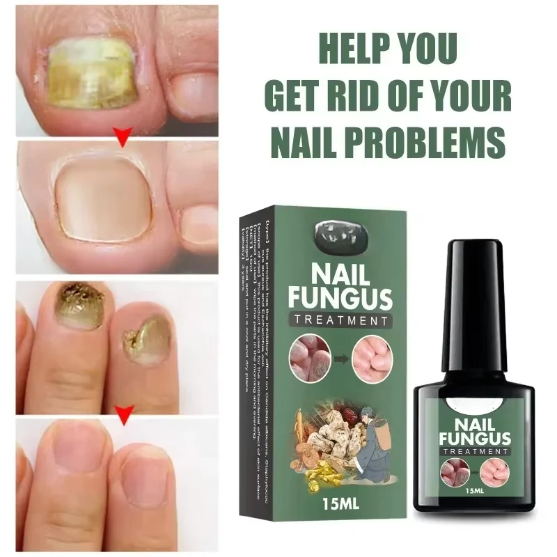 Nail Fungal Treatment Essence Oil Foot Toe Nail Fungus Removal Serum 7 Days Repair Onychomycosi Anti Infection Gel Care Products nail fungus remover