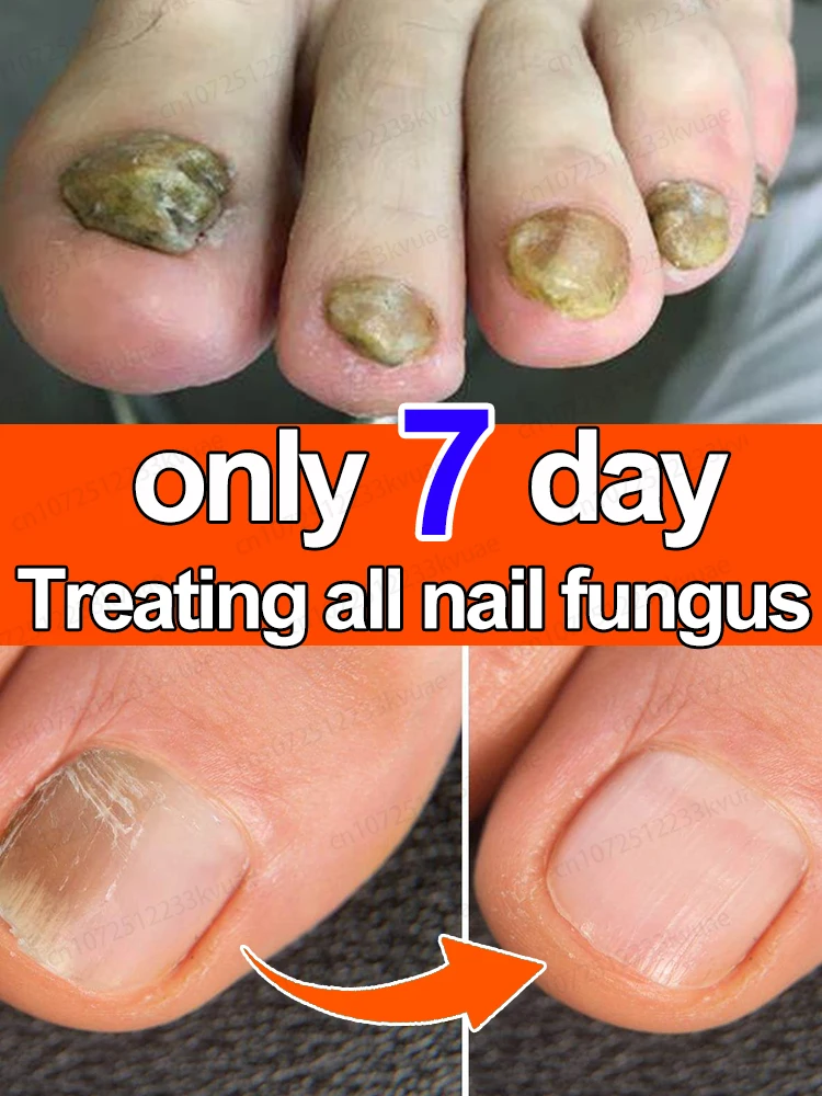 Nail fungus treatment essential oil repair onychomycosis in 7 days