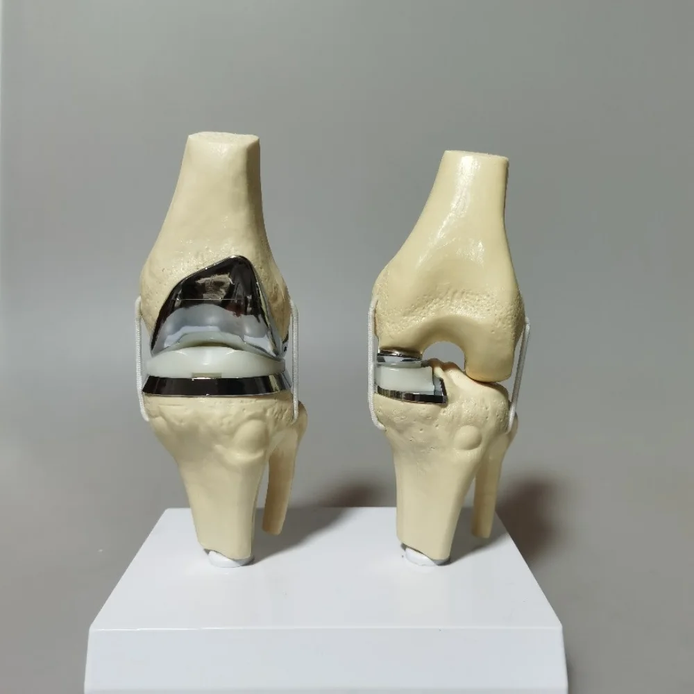 Detachable Artificial Knee Prosthesis Model Small Double Silver Knee Joint Implant Model Set