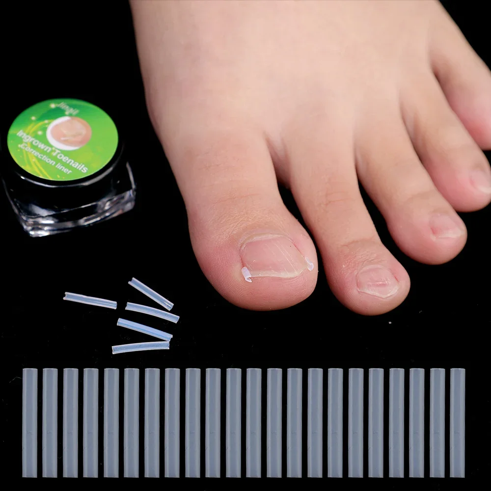 Medical Grade Plastic Ingrown Toenail Corrector Tool