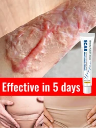 scar removal cream for old scars and gel removal ointment from keloid