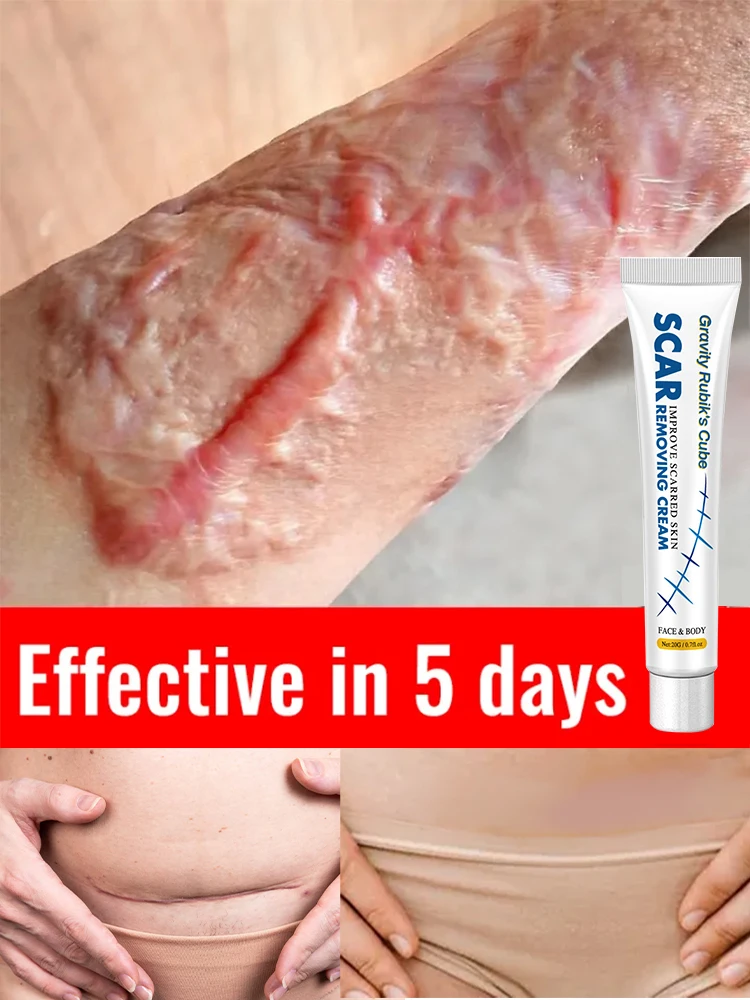 scarremovalcreamforoldscarsandgelremovalointmentfromkeloid.jpg