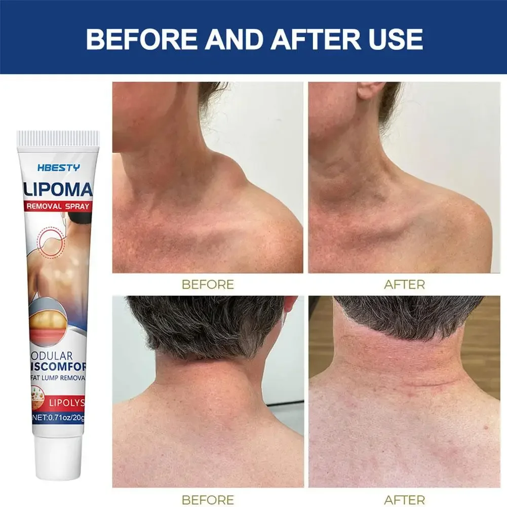 Lipoma Removal Cream Effective Antitumor Remove Fat Lump Ointment Herbal Extracts Nodular Skin Cyst Swelling Painless Treatment pain relief cream,skin care ointment,knee pain relief cream,hemorrhoids treatment cream,antibacterial anti fungal cream,sex delay cream