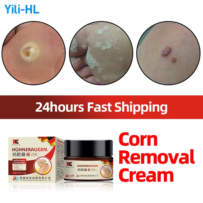 

Corn Removal Cream Wart Calluses Callosity Plantar Warts Remover Foot Corns Treatment Medicine Feet Care German Secret Recipe