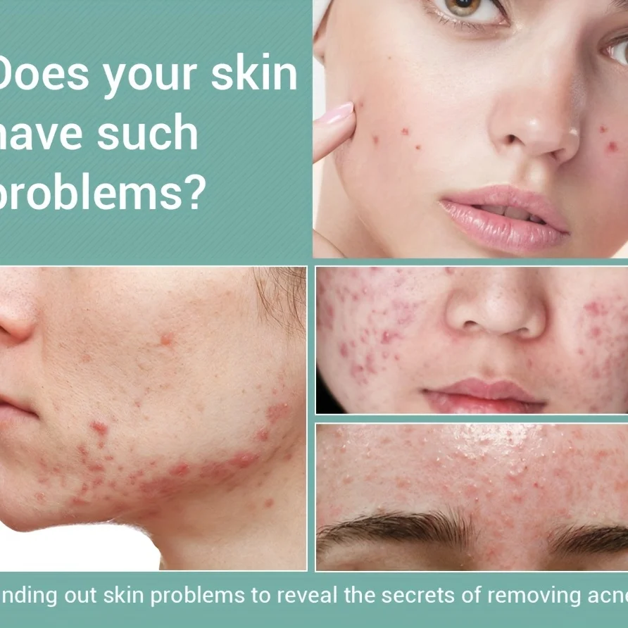 Herbs Face Serum Acne Treatment Essence Pimple Removal Moisturizing Repairing Serum Facial Skin Care Mild acne treatment