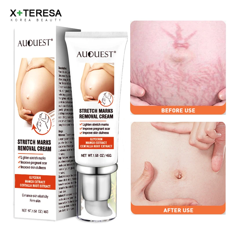 Maternity Scars Cream Pregnancy Stretch Marks Remove Cream 7 Day Effect ESSENTI Skin Care Repair Anti-White Stretch 45g