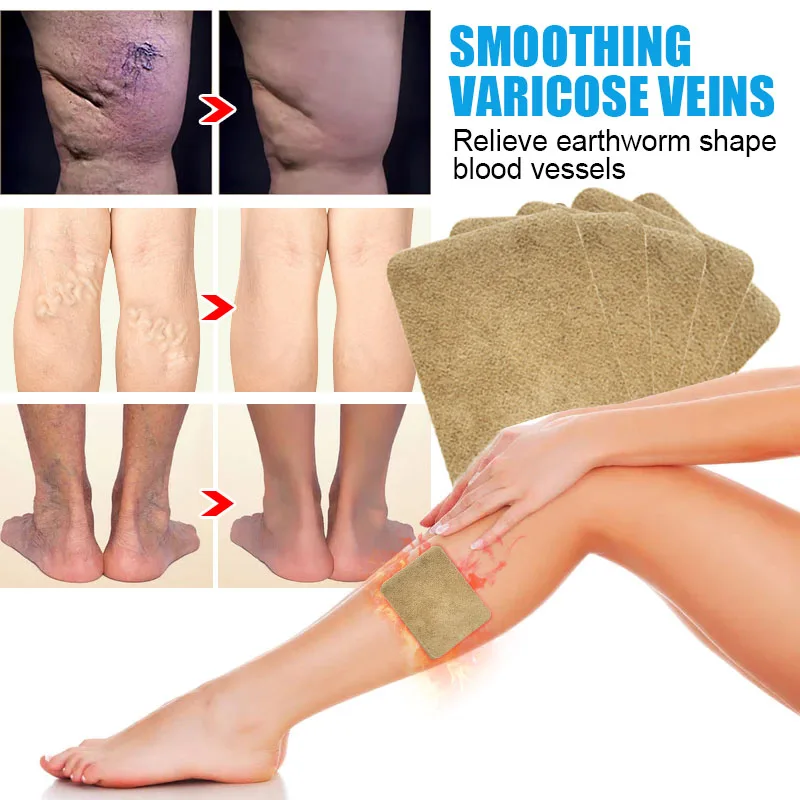 Varicose vein patch for treatment of varicose muscle vasculitis alleviating muscle swelling pain 6pcs=1bag