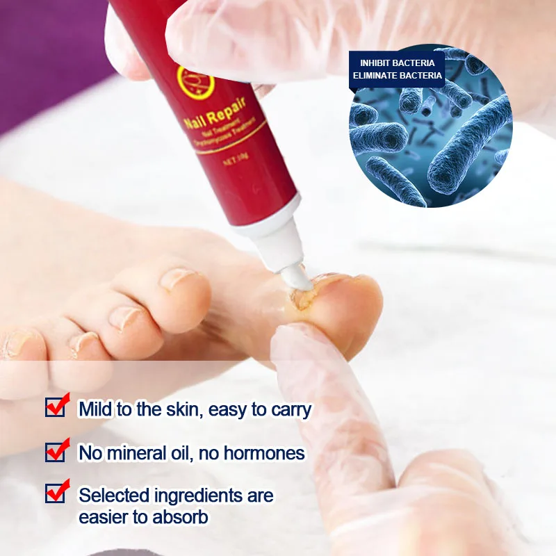 Treatment Fungal Nail Ointment Care Repair Foot Nail Fungus Removal Cream Anti Infection Paronychia Onychomycosis Product
