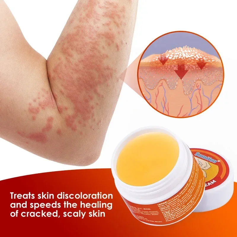 Herbal Skin Cream for Psoriasis Dermatitis