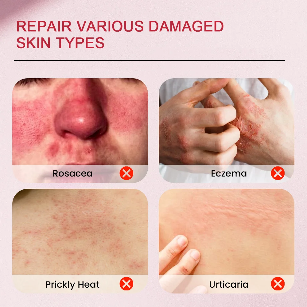 Skin Care , facial, skin care,Sumifun， Adolescence， Antibacterial Cream, Acne Cream 20g